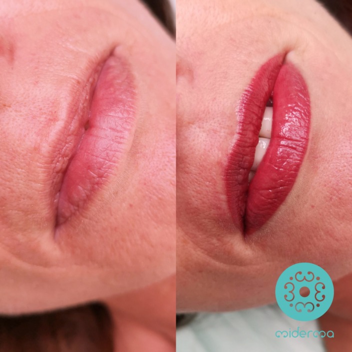 Vorher Nacher optische Anpassung schmale Oberlippe Vorher Nacher optische Anpassung schmale Oberlippe