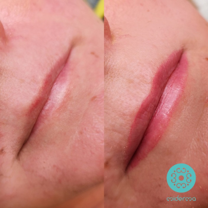 schmale Lippe Vergrößerung in natürlicher Optik -abgeheilt schmale Lippe Vergrößerung in natürlicher Optik -abgeheilt nach erster Sitzung