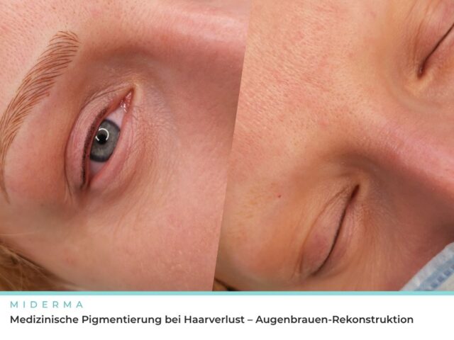 Medizinische Pigmentierung bei Haarverlust – Augenbrauen-Rekonstruktion