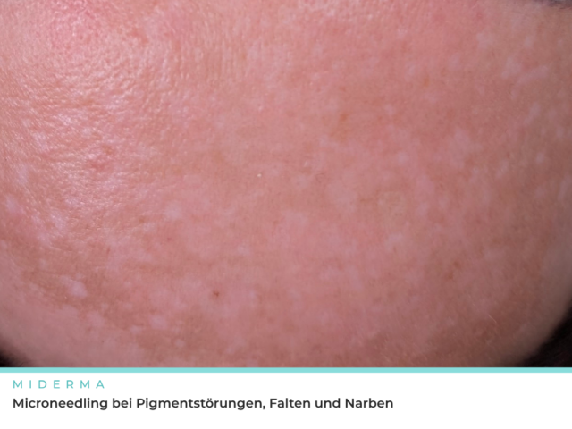 Microneedling für Narben, Falten und Pigmentstörungen: warum die Technik entscheidet