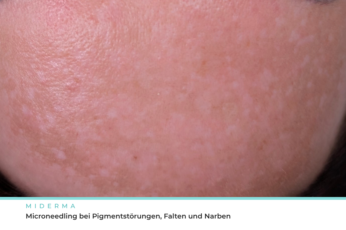Microneedling bei Narben und Falten, Behandlung bei Miderma