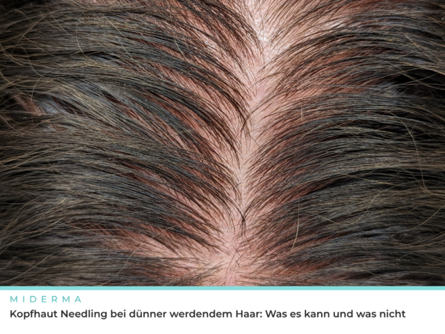 Kopfhaut Needling bei dünner werdendem Haar: Was es kann und was nicht