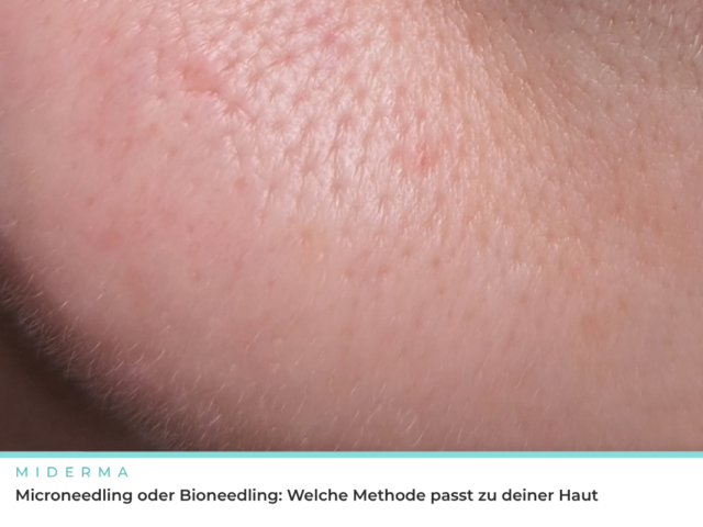 Microneedling oder Bioneedling: Welche Methode passt zu deiner Haut