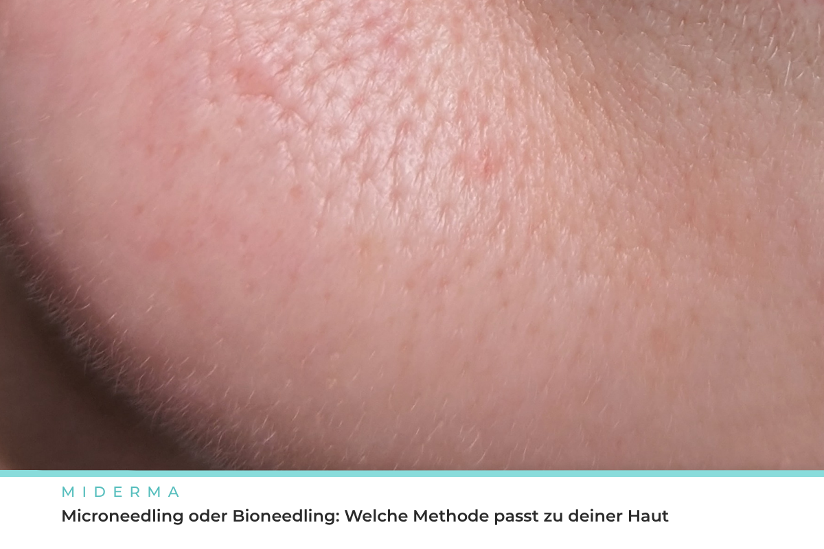 Microneedling und Bioneedling im Vergleich bei Miderma