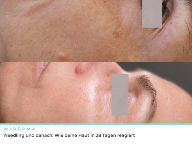 Needling und danach: Wie deine Haut in 28 Tagen reagiert