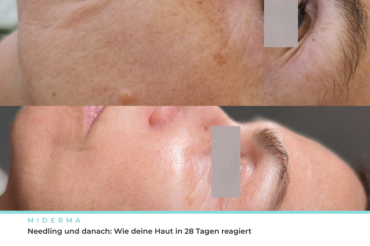 Wirkung von Microneedling in der Haut, Fachbeitrag von Melanie Miniaci