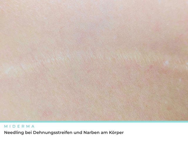Needling bei Dehnungsstreifen und Narben am Körper