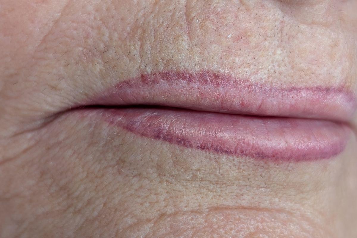 Überzeichnetes Lippen Permanent Make-up aus einem anderen Studio, nicht von Miderma, vor der Korrektur